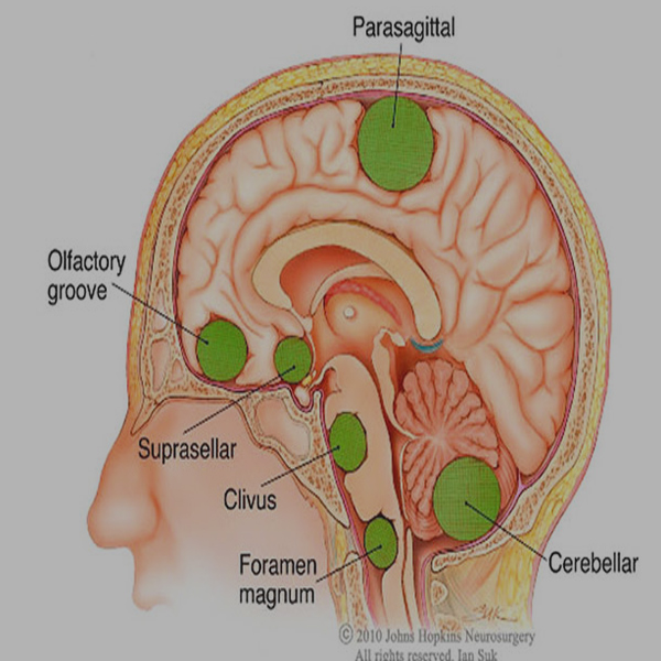 Brain Tumor