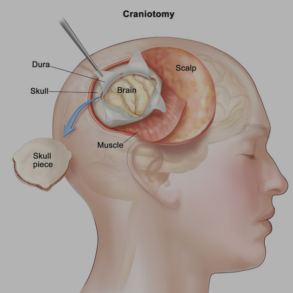 Brain Tumor