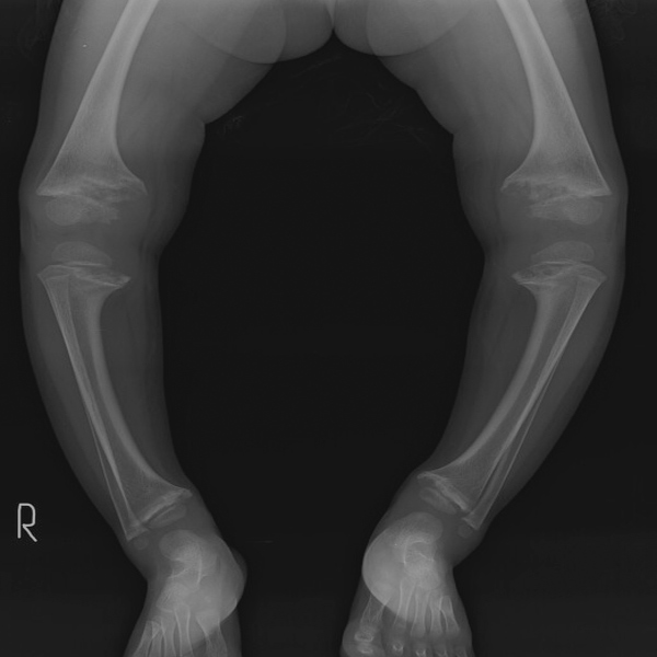 Rickets   