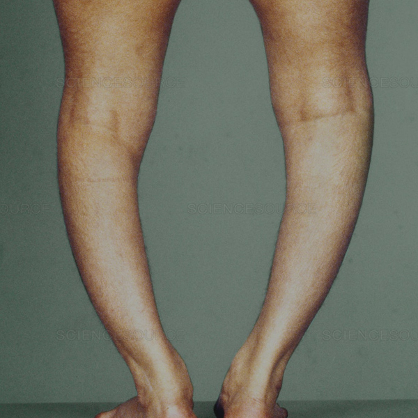 Rickets   