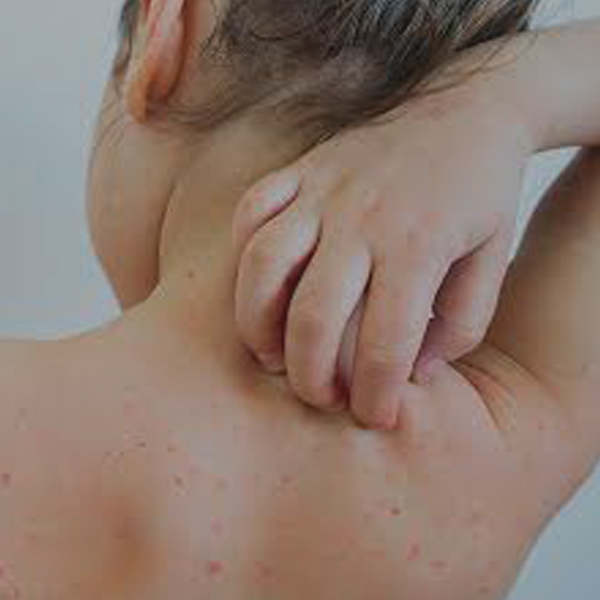 Chicken Pox