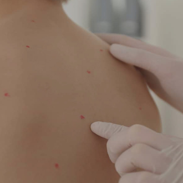 Chicken Pox