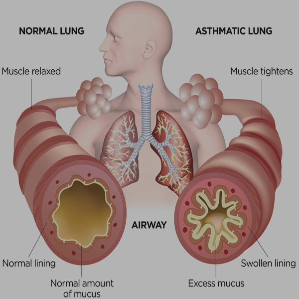 Asthma  