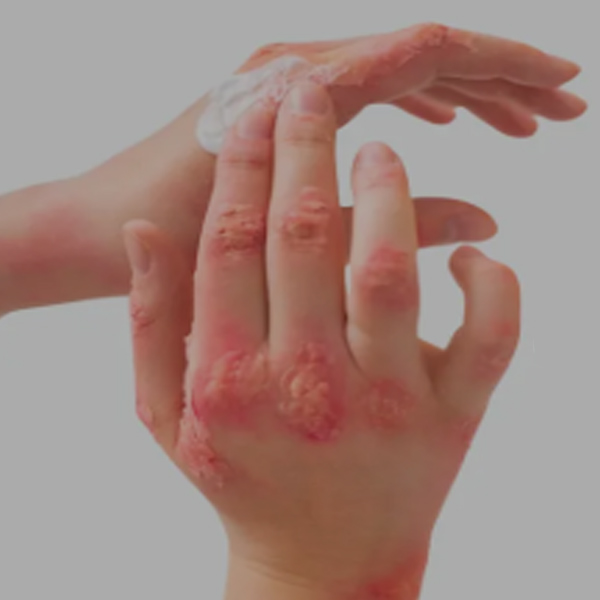 Burn image